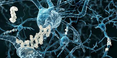 Alzheimers disease neurons with amyloid plaques